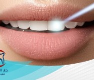 50% discount on taking off the milk tooth or baby fillings for 50 riyals