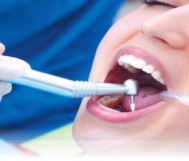 Cleaning teeth for 190 riyals and get the same service for another person for free