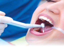 Cleaning teeth for 190 riyals and get the same service for another person for free