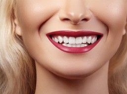 Hollywood smile (veneers) 16 years for 4900 riyals