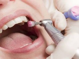 Teeth cleaning and lime removal + treatment plan for 129 riyals