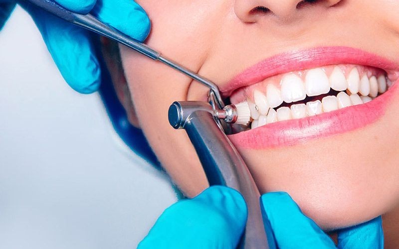 33% discount on laser teeth whitening, panorama rays, kemposit filling and fittings (Zircon- IMAX)