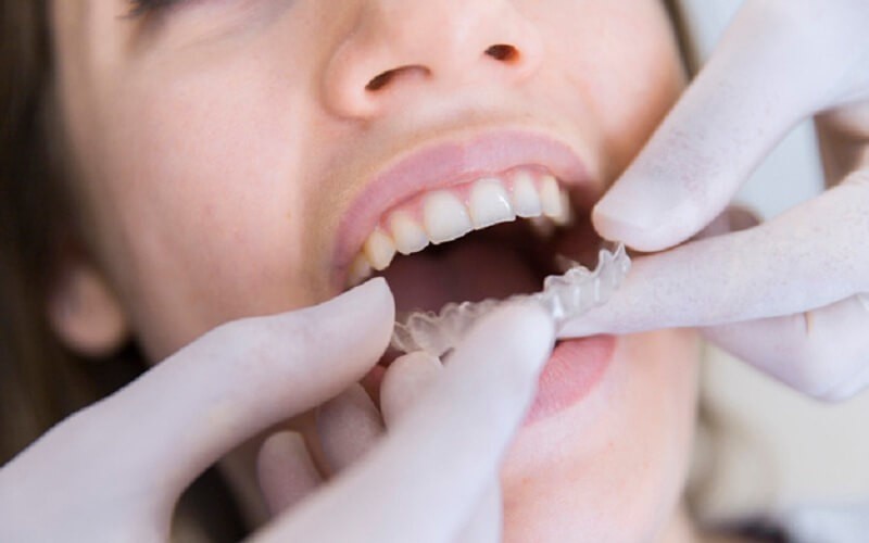 Laser teeth whitening includes cleaning, polishing and lime removal for 349 riyals