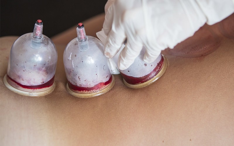 3 immune cupping cups for 90 SR instead of 120 SR